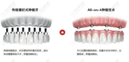 ALL-on-4即刻種植牙