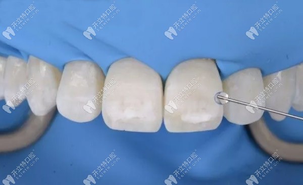 斑點還是存在，需要進一步酸蝕