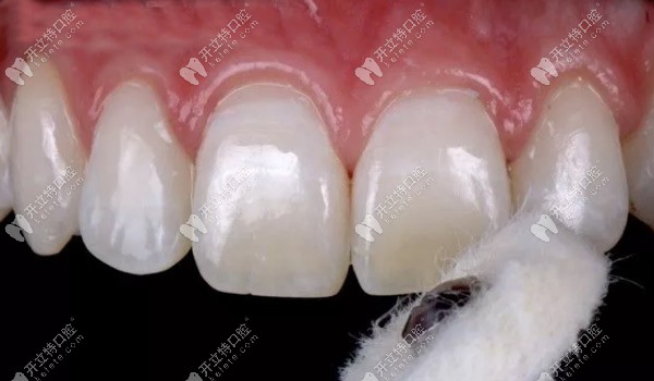 撤回橡皮障并對表面進行拋光