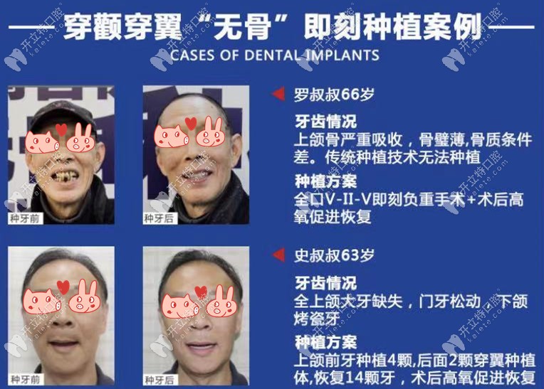 穿顴穿翼種牙案例圖片展示