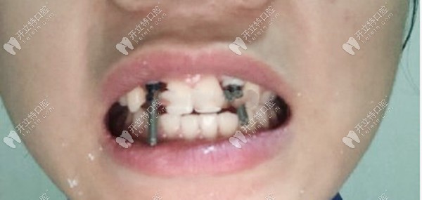 上頜兩顆側(cè)切牙缺失種植