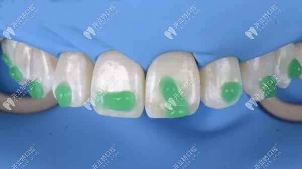 使用15%鹽酸凝膠酸蝕120秒