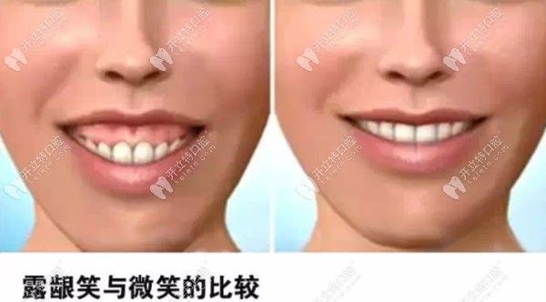 露齦笑與正常微笑的對(duì)比圖