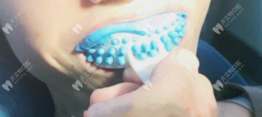 當天咬模型 當天咬模型