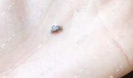 托槽掉了 托槽掉了