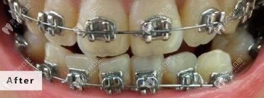 戴牙套一年零三個月的變化