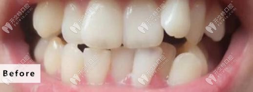 牙齒矯正前的外觀