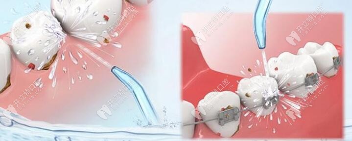 洗牙可是不會(huì)疼的，就是有點(diǎn)小麻