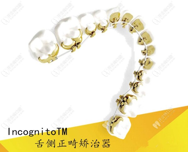 incognito舌側(cè)隱形牙套