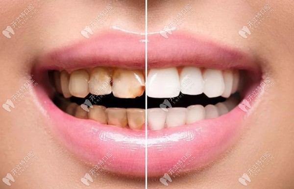 瓷優(yōu)健與瓷倍健全瓷牙哪個好