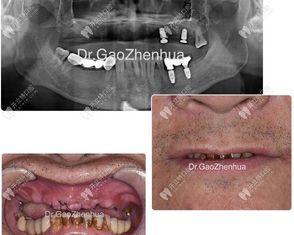 馮先生種植失敗后拍的CT片