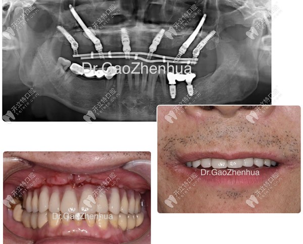 當天做完VIIV穿顴穿翼手術(shù)