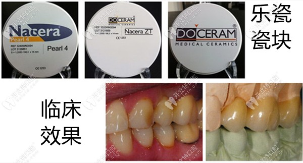 德國(guó)杜塞拉姆全瓷牙臨床效果