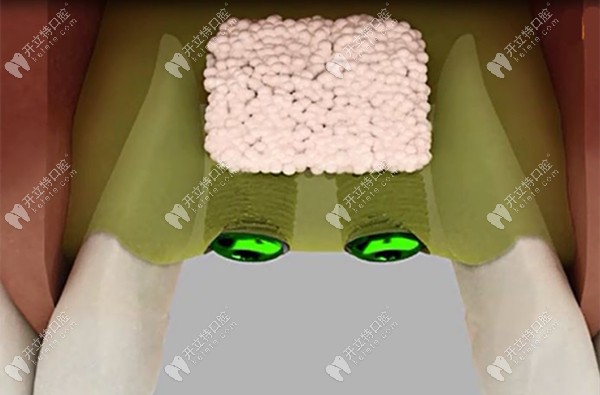 骨劈開(kāi)過(guò)程中加入骨粉