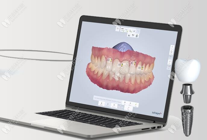 數(shù)字導(dǎo)板導(dǎo)航種植牙 數(shù)字導(dǎo)板導(dǎo)航種植牙