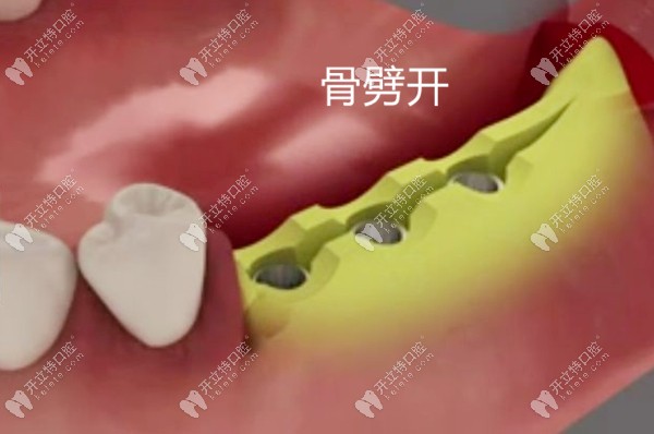 骨劈開(kāi)術(shù)過(guò)程演示