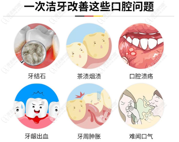 德國(guó)KAVO氣動(dòng)聲波潔牙改善口腔問(wèn)題