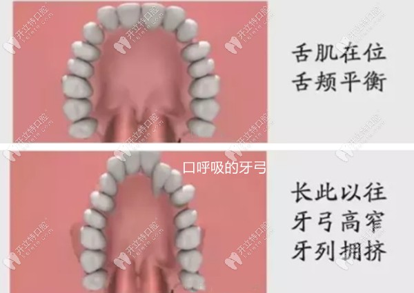 正常牙弓和長期口呼吸牙弓對比 正常牙弓和長期口呼吸牙弓對比