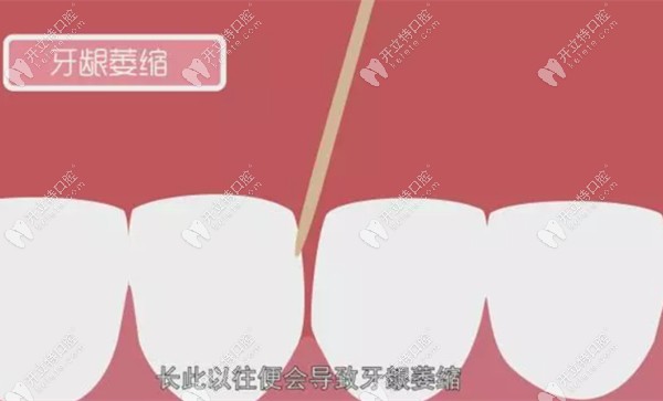牙簽會導(dǎo)致牙齦萎縮