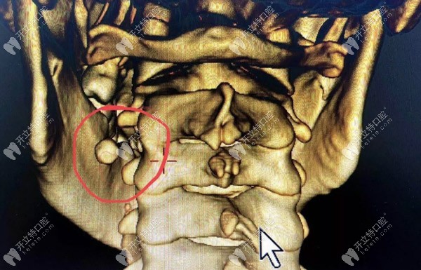 罕見的涎石癥也會(huì)引起口腔下頜腫脹、疼痛