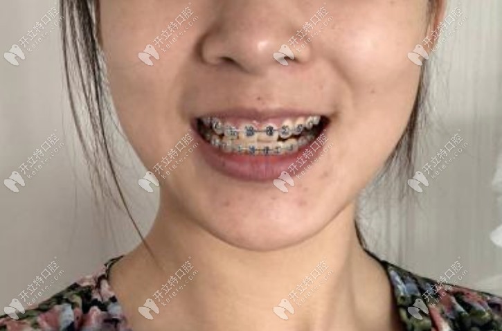 矯正后期快摘牙套了