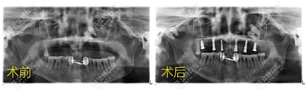 案例|半口6顆植體做即刻種植牙只要2小時,且當天戴冠吃東西