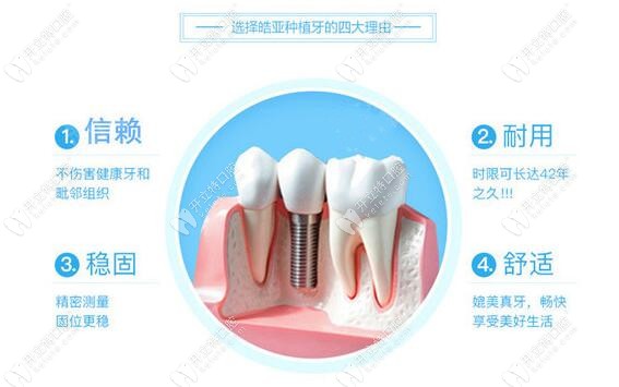 HIOSSEN皓圣種植系統(tǒng)的4大優(yōu)勢(shì)