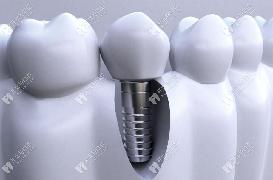 微創(chuàng)種植牙修復(fù)技術(shù)