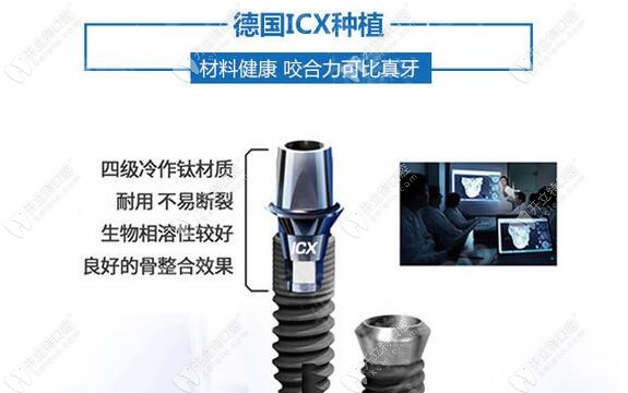德國(guó)icx種植牙的材料介紹與特征