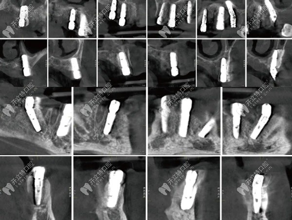 術(shù)后即刻CBCT種植體冠狀、矢狀面影像