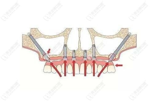 穿顴穿翼種植牙手術(shù)