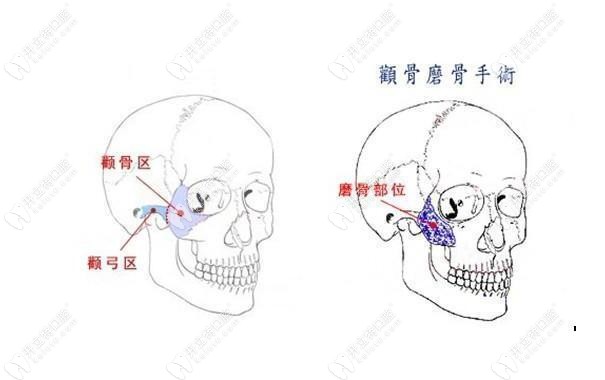 顴骨和翼板位置