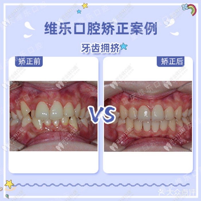 重慶維樂口腔damon自鎖矯正案例