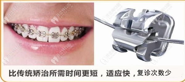 美國damon自鎖托槽快速矯正的技術原理