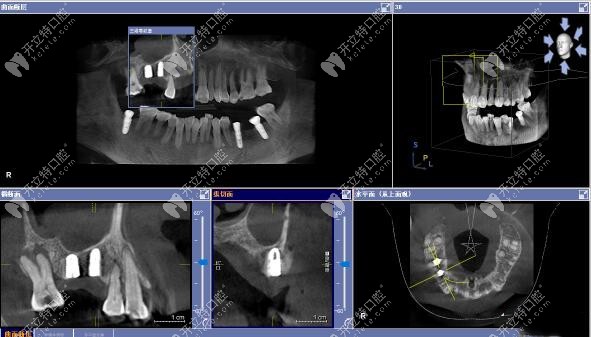 3D數(shù)字化導(dǎo)板上頜竇區(qū)種植案例