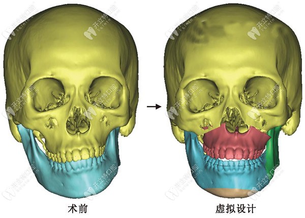 上海哪個醫(yī)院做正頜手術好,選個厲害的頜面外科醫(yī)生很關鍵