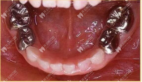 金屬預(yù)成冠