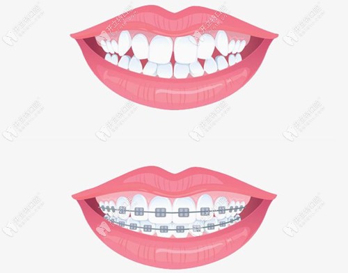 牙齒矯正前后對(duì)比