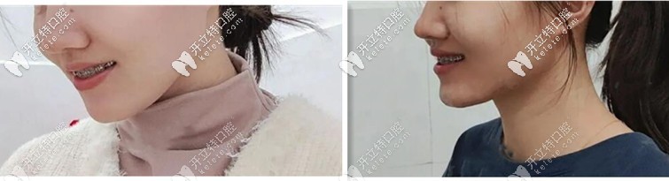 二次矯正：我決定在德益口腔做國產(chǎn)金屬托槽正畸經(jīng)歷！