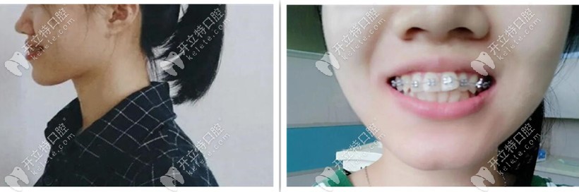 牙套兩個(gè)月側(cè)臉，嘴還是突