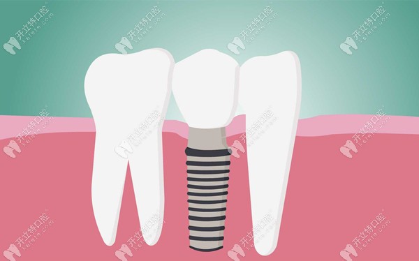 德國(guó)種植系統(tǒng)中的ICX和camlog對(duì)比