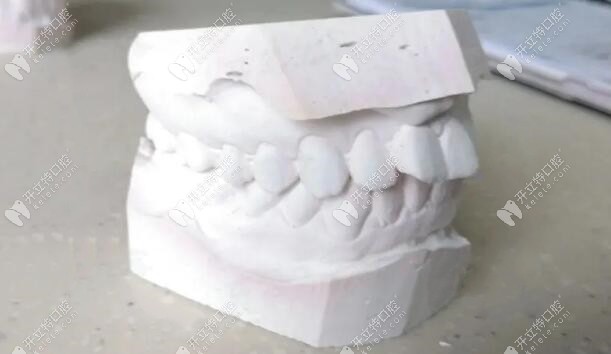 門牙有點(diǎn)凸嘴，牙齒不齊