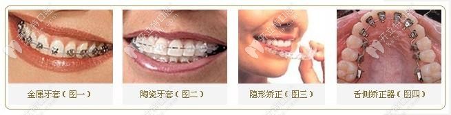不同的矯正器對(duì)比