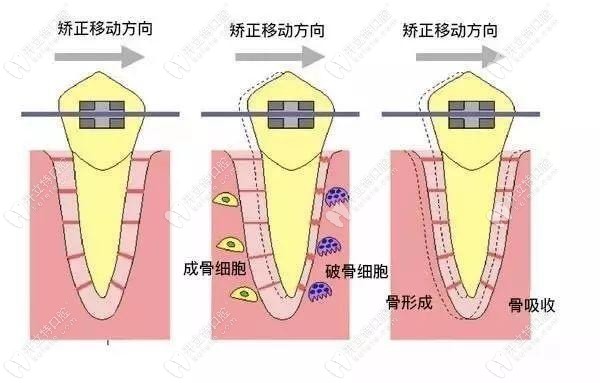 牙齒矯正時(shí)的移動(dòng)方向