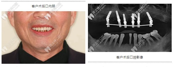 典型重度牙周炎種植案例:如何實現(xiàn)即刻種植與即刻修復(fù)？