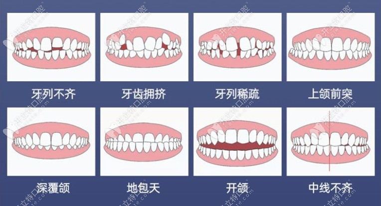 牙齒正畸適應癥狀