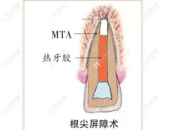 mta在根尖屏障術(shù)里的應用