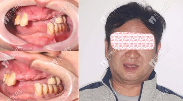 梁先生術(shù)前口內(nèi)情況 梁先生術(shù)前口內(nèi)情況