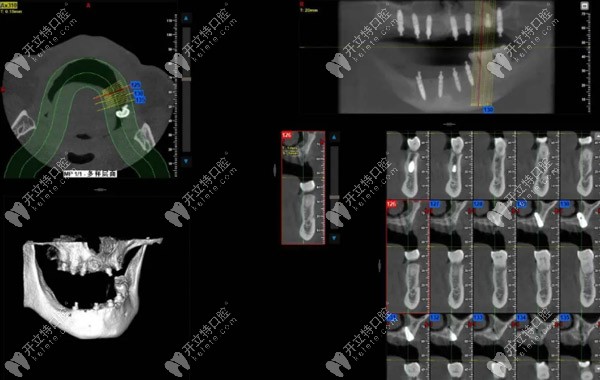 梁先生術(shù)后ct 梁先生術(shù)后ct