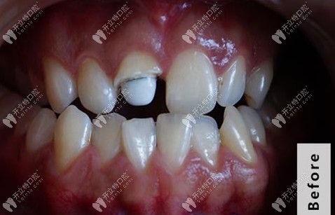 剛裝上纖維樁的牙齒外觀(guān)